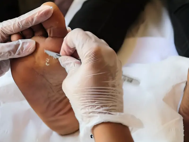 Callus Removal at Luxury Nails and Spa