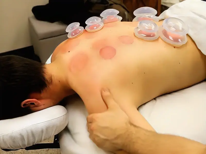 Cupping Therapy at Le Foot Reflexology Spa